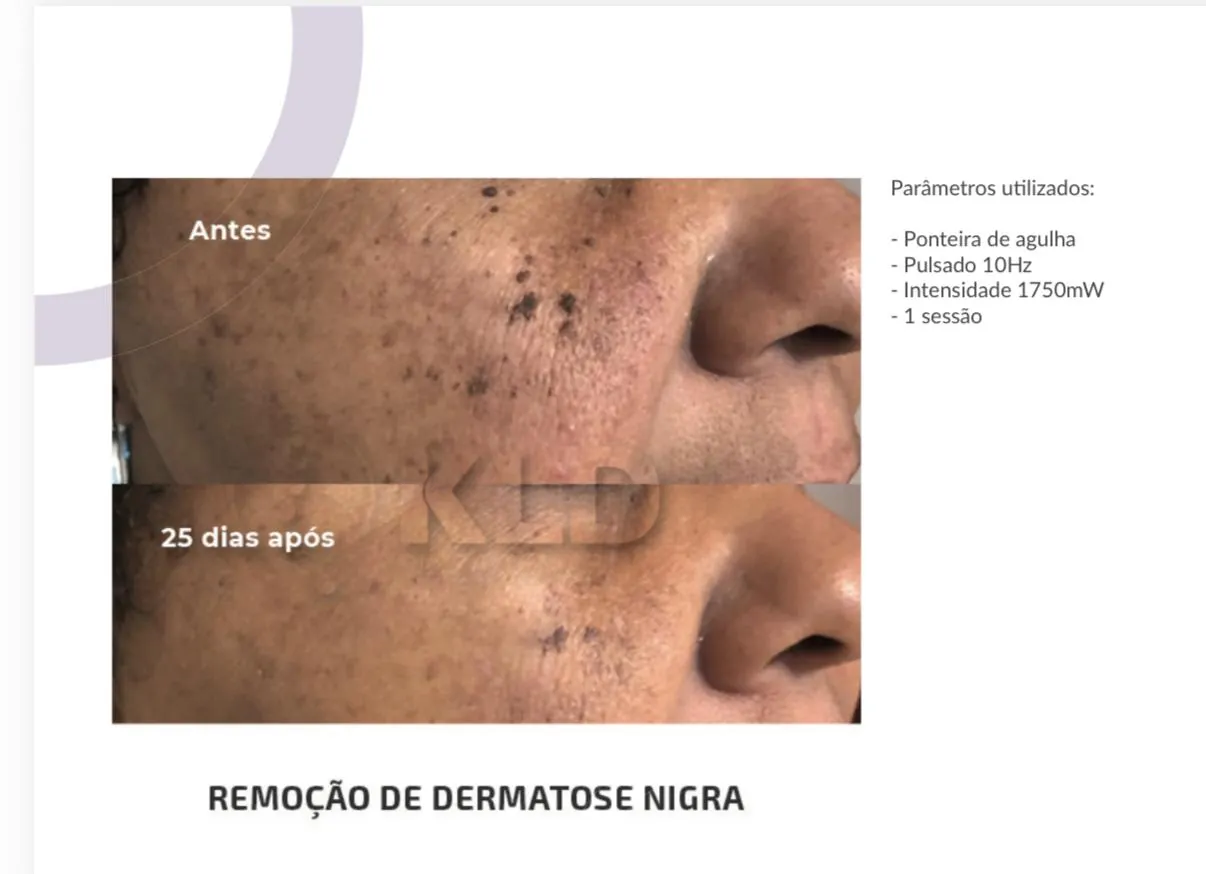 Antes e 25 dias depois de remoção de dermatose nigra com Jato de Plasma