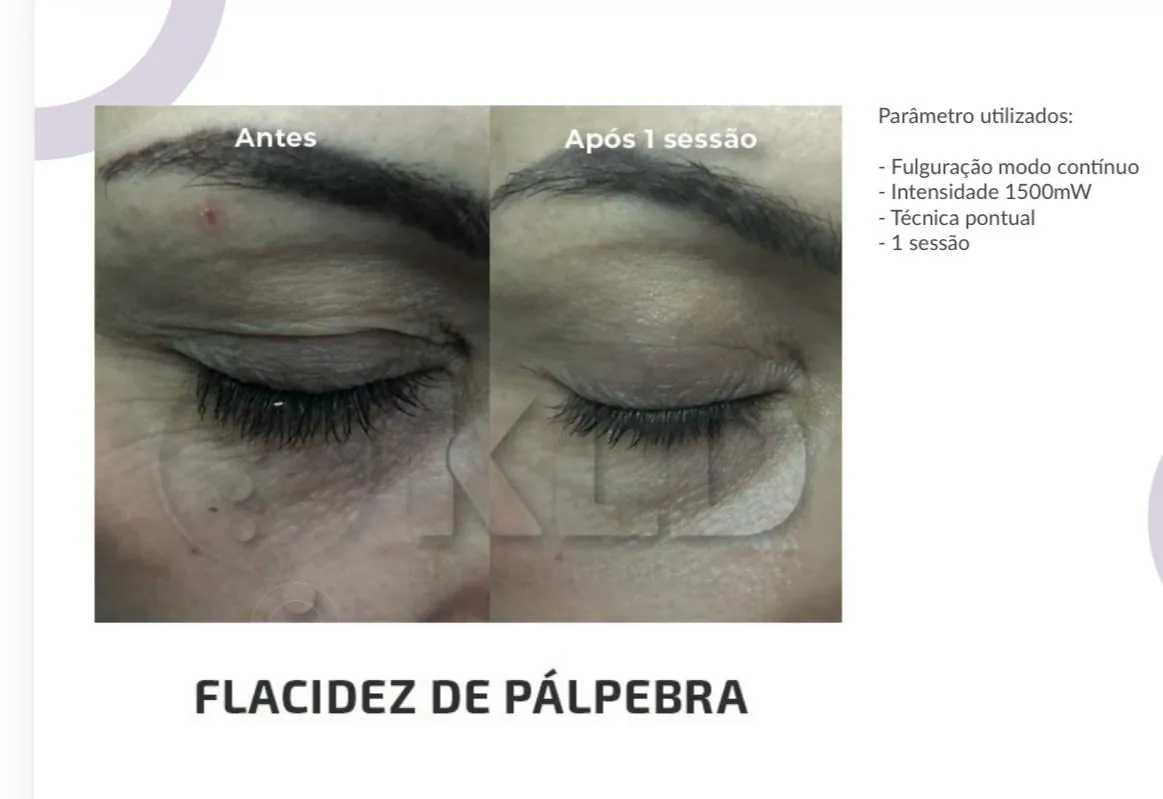 Antes e depois de tratamento de flacidez de pálpebra com Jato de Plasma, após 1 sessão