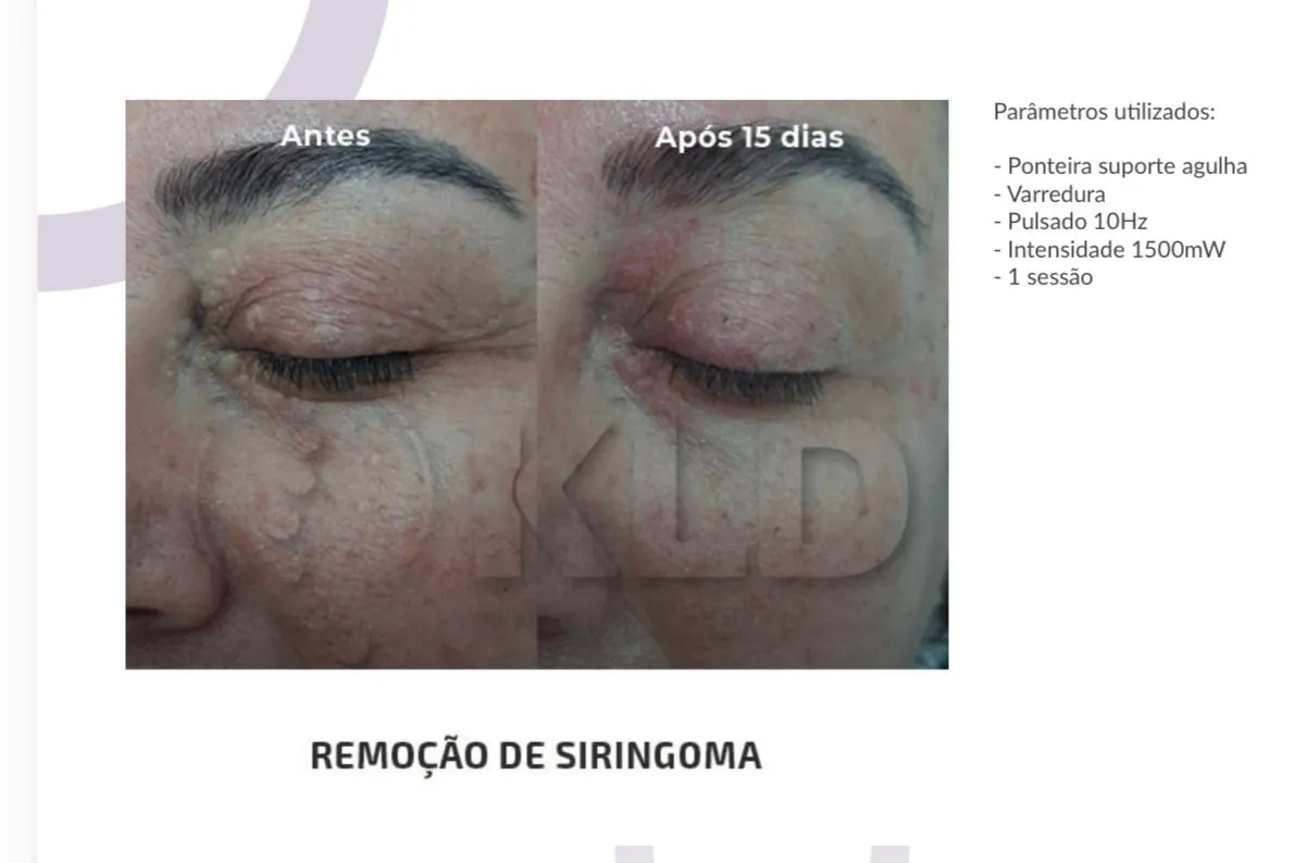 Antes e 15 dias depois de remoção de siringoma com Jato de Plasma