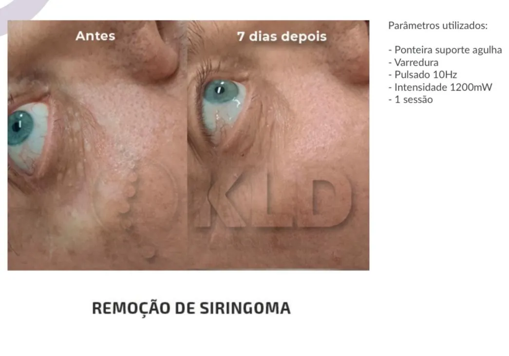 Antes e 7 dias depois de remoção de siringoma na região dos olhos com Jato de Plasma